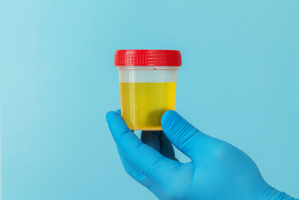 An image of a urine sample intended for laboratory analysis to detect protein levels in the urine.