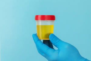An image of a urine sample intended for laboratory analysis to detect protein levels in the urine.