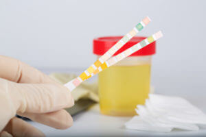A Urine collection cup with test strips on a lab technician's table to check for protein levels in urine.