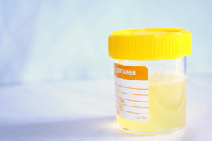 A urine sample for testing protein levels by a nephrologist.