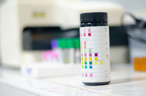 Urine strip with scientist in lab, checking for protein in your urine.