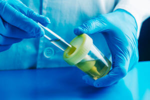 Man in the lab filling a tube with a urine sample for protein in urine test.