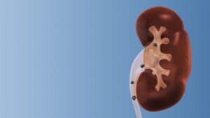 Kidney stones treatment medical concept